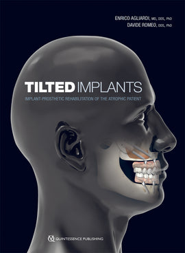Tilted Implants