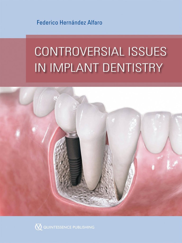 Controversial Issues in Implant Dentistry