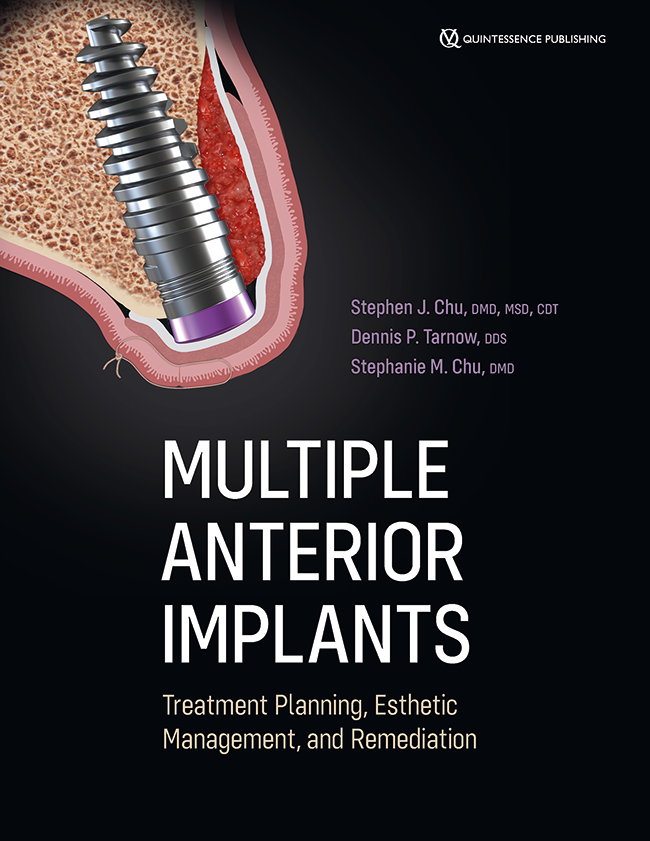 Multiple Anterior Implants