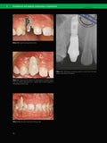 Atlas komplikacija i neuspjeha u dentalnoj implantologiji - AKCIJA ZA PRETPLATNIKE