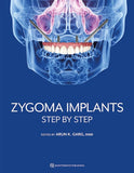 Zygoma Implants