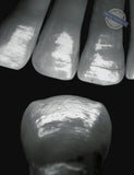 Adhezivno cementirani keramički nadomjesci u prednjoj denticiji