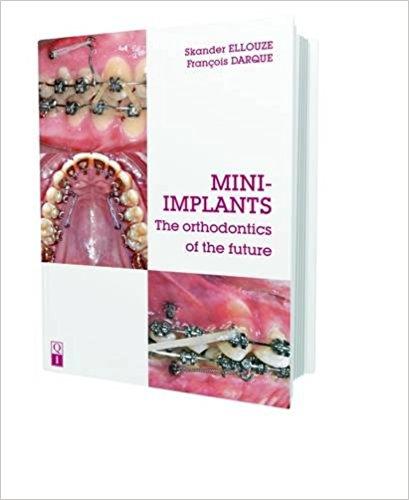 Mini Implants