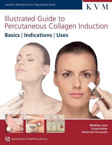 Illustrated Guide to Percutaneous Collagen Induction KVM