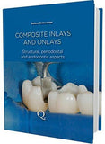 Composite Inlays and Onlays