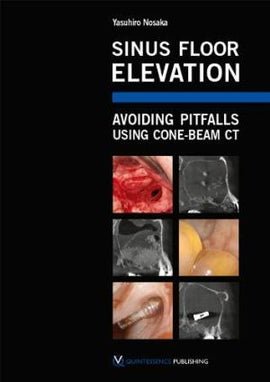 Sinus Floor Elevation