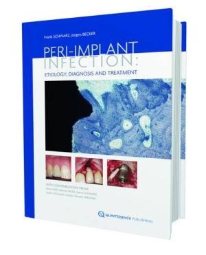 Peri-Implant Infection