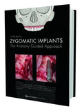 Zygomatic Implants