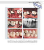 Ortodontska i kirurška terapija impaktiranih zubi