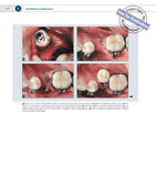 Ortodontska i kirurška terapija impaktiranih zubi