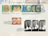 Postendodontska opskrba zubi - vodič za kliničare