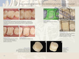 Postendodontska opskrba zubi - vodič za kliničare