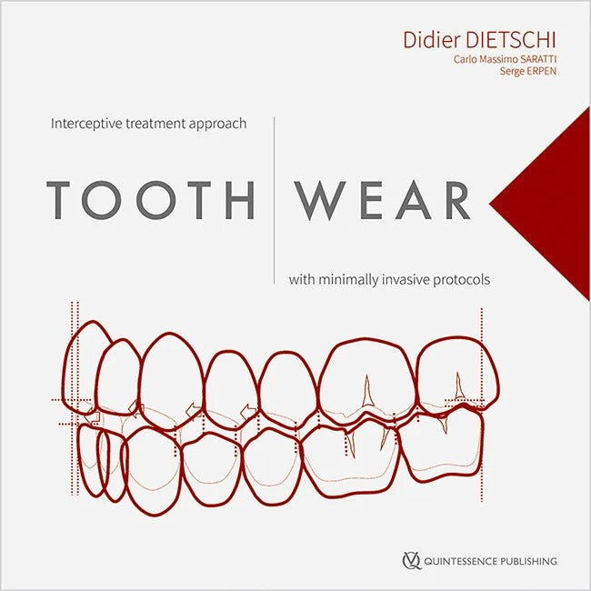 Tooth Wear - Interceptive treatment approach with minimally invasive protocols