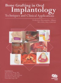 Bone Grafting in Oral Implantology: Techniques and Clinical Applications