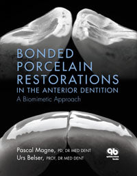 Bonded Porcelain Restorations in the Anterior Dentition