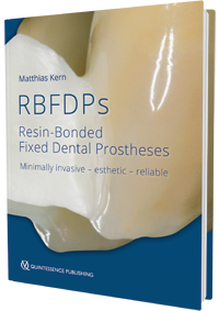 RBFDPs - Resin-Bonded Fixed Dental Prostheses