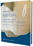 RBFDPs - Resin-Bonded Fixed Dental Prostheses