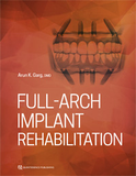 Full-Arch Implant Rehabilitation