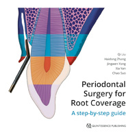 Periodontal Surgery for Root Coverage                                             A step-by-step guide