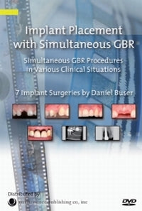 Implant Placement with Simultaneous GBR